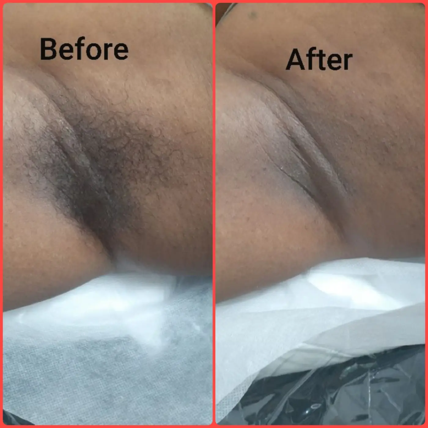 Brazilian wax photo — bikini line variation comparison