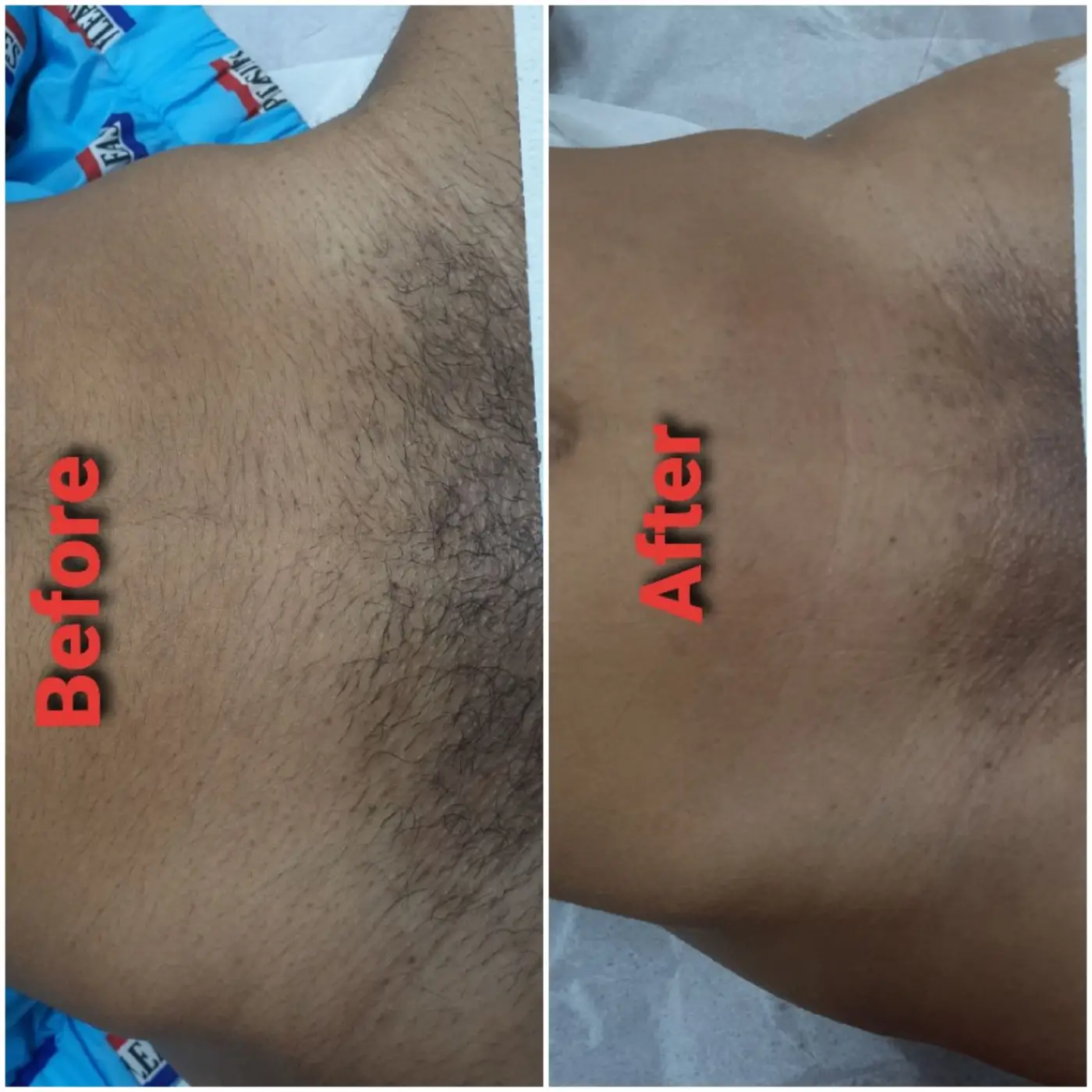 Underarm waxing before and after results at Magical Waxing - clean smooth underarms after professional waxing