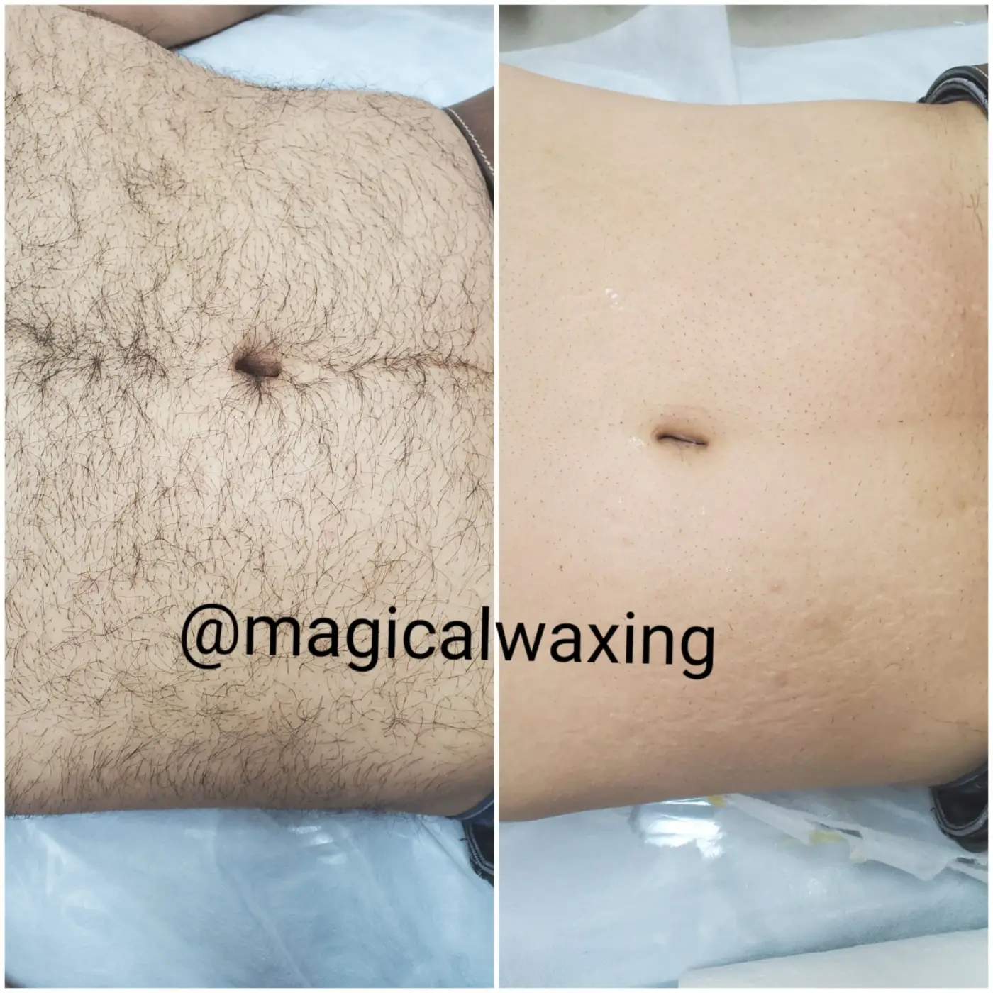 Brazilian wax photo — extended stomach and lower abdomen results